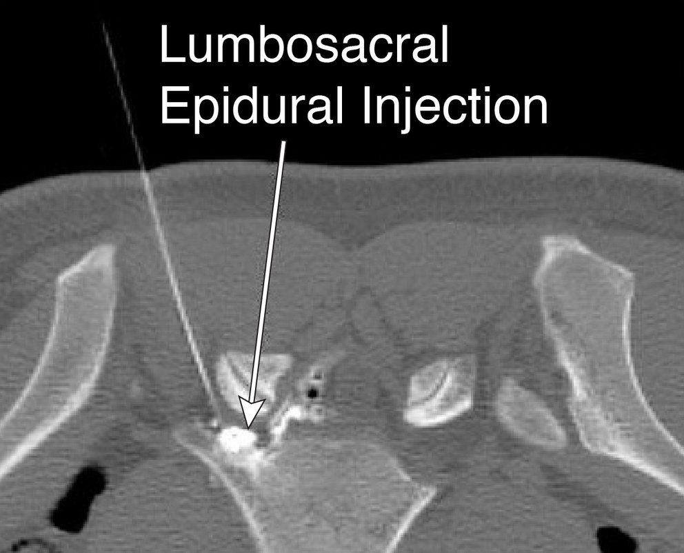 Epidural Steroid Injection Larkin Health